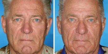 Sigara İçen ve İçmeyen İkizler Üzerinden Sigaranın Zararlarını Anlamak