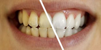 Daha Beyaz Dişler İçin Yapmanız Gereken 8 Şey