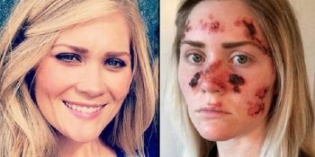 Solaryum Yüzünden Cilt Kanserine Yakalanan Tawny’in 5 Fotoğrafla Hüzünlü Hikayesi