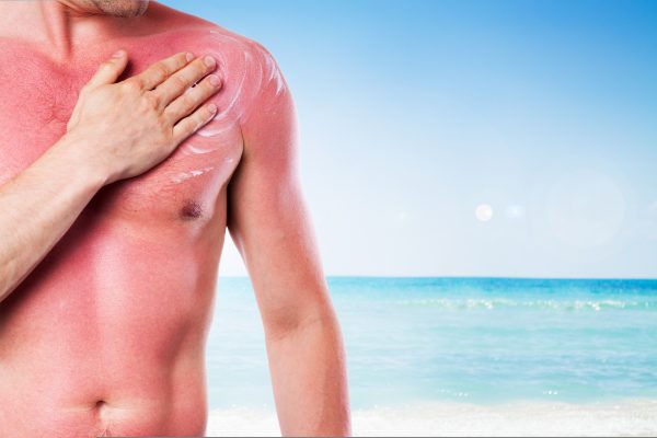 Man with a sunburn isolated on white background