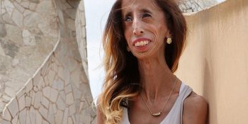 Cesaretiyle Hayatta Asla Vazgeçmemeyi Öğreten “Dünyanın En Çirkin Kadını” Lizzie Velasquez