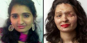 Uğradığı Asit Saldırısı Sonucu Hayatı Değişen Reshma Qureshi’nin İlham Veren Hikayesi