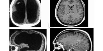 Bilim Dünyasını Şoka Sokan Bir Hikaye: Beyninin Yüzde Doksanı Olmadan Yaşayan Adam