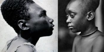 Hala Dünyanın Belli Bölgelerinde Uygulanan İnsanlık Tarihinin İlk Estetik Takıntısı: Kafatası Uzatma