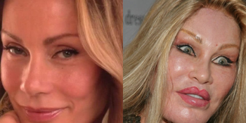 Kocasına Güzel Görünmek Uğruna Bir Düzine Estetik Operasyon Geçiren “Kedi Kadın”