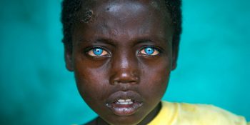 Waardenburg Sendromuna Sahip Okyanus Gözlü Siyahi Çocuk Abushe’ın Hikayesi