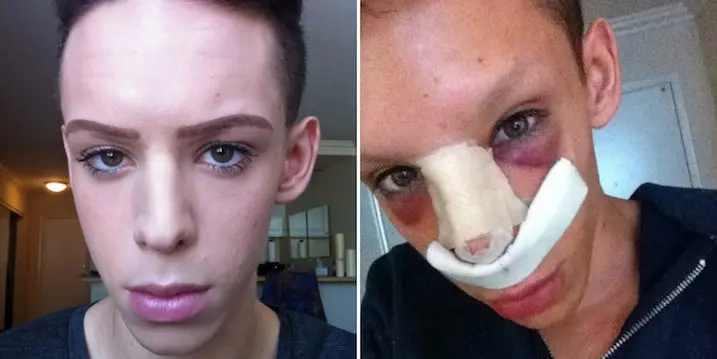before-after-surgey