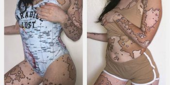 Vücudunu Tuvale Çeviren Vitiligolu Genç Kadının Hayranlık Uyandıran Hikayesi