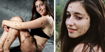Doğum Lekeleri Yüzünden Zorbalığa Maruz Kalan Kızın Modelliğe Uzanan Öyküsü