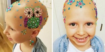 Alopesi Yüzünden Saçı Dökülen Küçük Kızının Yüzünü Yeniden Gülümseten Anne