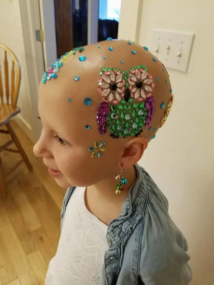girl-alopecia-crazy-hair-day-gianessa-wride-2