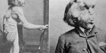 Hastalığı Ölümünden Yüz Yıl Sonra Saptanan Joseph Merrick’in Üzücü Hayat Hikayesi