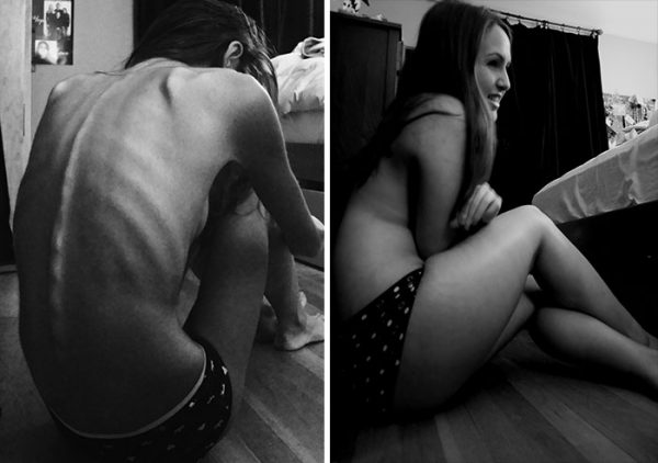 anorexia-recovery-before-after-105-58f5c387a8322__700