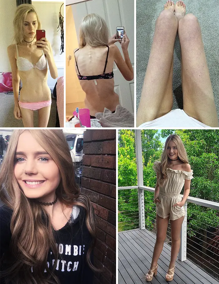 anorexia-recovery-before-after-139-58f7ada9e0418__700