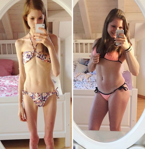 anorexia-recovery-before-after-195-59100917d9eb6__700