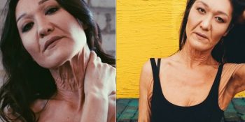 Beş Binde Bir Görülen Bir Rahatsızlık Sonucu Olduğundan Çok Daha Yaşlı Görünen Model