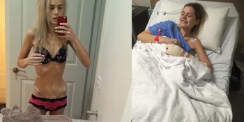 “Şişko Balina” Dendiği İçin Anoreksiyaya Yakalanıp 34 Kiloya Düşen Genç Kızın Zaferi
