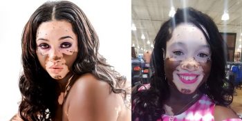 Kendisi Gibi Deri Hastalığı Olanlara İlham Vermek İçin Modellik Yapan Büyükanne