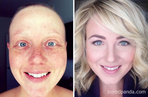 before-after-beating-cancer-25-5992e4449906e__700