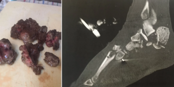 Motosiklet Kazasında Parçalanan Bacağını Arkadaşlari İle Yiyen Adamın Hikayesi