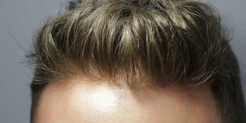 Protez Saç Hakkında Bilmeniz Gereken 7 Önemli Bilgi