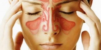 7 Maddede Sinüzit Nedir? Sinüzit Belirtileri Nelerdir?