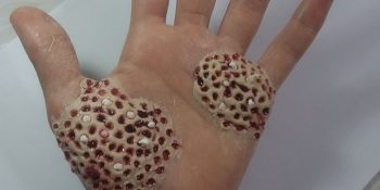 İsmini Duyunca Bile Vücudumuzda Kaşıntılar Oluşturan Tripofobi Hakkında Bilmeniz Gereken 8 Madde