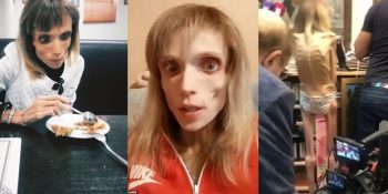 Doktorunun “Korku Filminde Oynayabilirsin” Dediği 17 Kilo Ağırlığındaki Anoreksiya Kadın