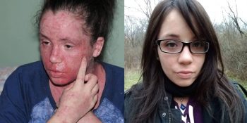 Kullandığı Kremleri Yüzünden Cildinde Derin Yanıklar Oluşan ve Saçları Dökülen Nina Ajdin