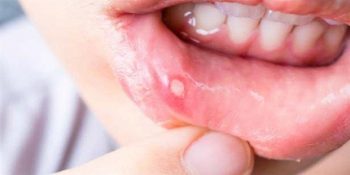 Ağzınızın Tadı Kaçmasın: Aft Nasıl Geçer?