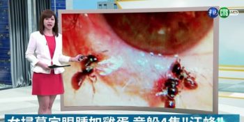 Enfeksiyon Endişesiyle Hastaneye Gidip Gözünde 4 Arının Yaşadığını Öğrenen Kadın