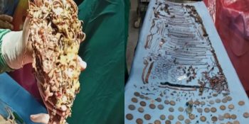 Midesinden Yaklaşık 2 Kilo Mücevher Çıkan Pika Sendromlu Kadın