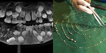 Ağzında Tam 547 Diş Olan Yedi Yaşındaki Hindistanlı Çocuk