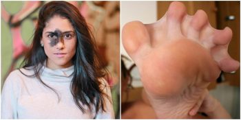 Dış Görünüşleriyle Herkesten Farklı Görünen 20 Genetik Harikası İnsan