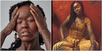 İktiyozis Hastalığı Nedeniyle İki Haftada Bir Deri Değiştiren Model Jeyza Gary