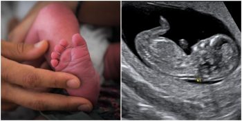 Portekiz’de Burnu ve Gözleri Olmadan Dünyaya Gelen Bebek