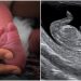 Portekiz’de Burnu ve Gözleri Olmadan Dünyaya Gelen Bebek