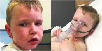 Kışa Alerjisi Olduğu İçin Aylarını Hastanede Geçiren 7 Yaşındaki Çocuk