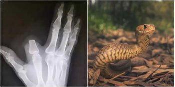 Yılan Isırığından Zehirlenmemek İçin Kendi Parmağını Kesen Adam