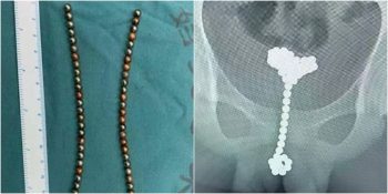 Penisindeki Manyetik Toplar Yüzünden Ölümden Dönen 14 Yaşındaki Çocuk