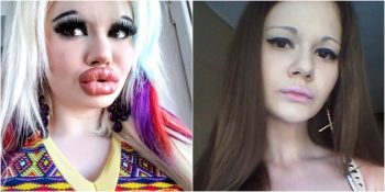 Yeterince Dolgun Olmadığını Düşündüğü Dudaklarına Sürekli Estetik Yaptıran Kadın