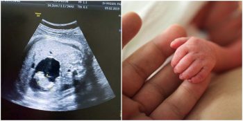 Kolombiya’da Anne Karnındayken Hamile Olduğu Fark Edilen Bebek