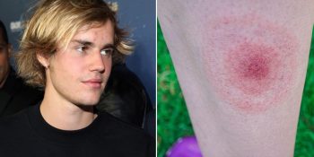 lyme hastalığı justin bieber
