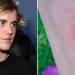 lyme hastalığı justin bieber