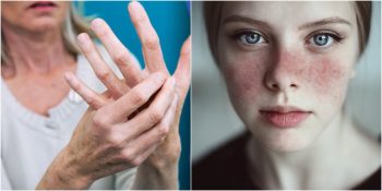 Oldukça Benzer Belirtiler Gösterip Yanlış Teşhis Konulmasına Neden Olan Hastalıklar