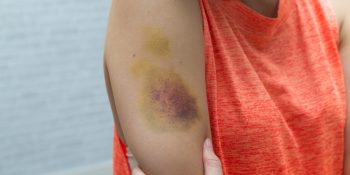 Vücudunuzdaki Açıklanamayan Morluklara Neden Olabilecek 7 Sağlık Sorunu