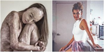 Trajik Bir Yangında Vücudunun Neredeyse Tamamı Yanan Avustralya Güzellik Kraliçesi Carol Mayer