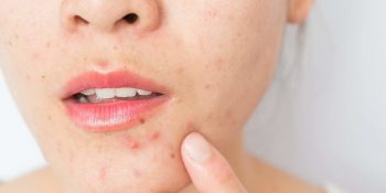 Cilt Sorunlarından Kurtulun: 6 Akne Çeşidi ve Oluşma Nedenleri