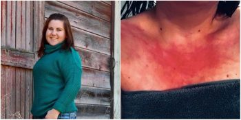 Suya Alerjisi Olduğu İçin Duş Alamayan 23 Yaşındaki Rachael Fetter