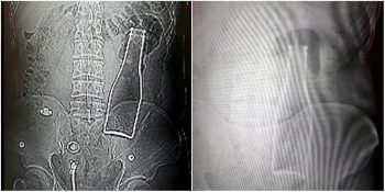 Karın Ağrısı Şikayetiyle Gittiği Hastanede Kalın Bağırsağında Soda Şişesi Tespit Edilen Adam